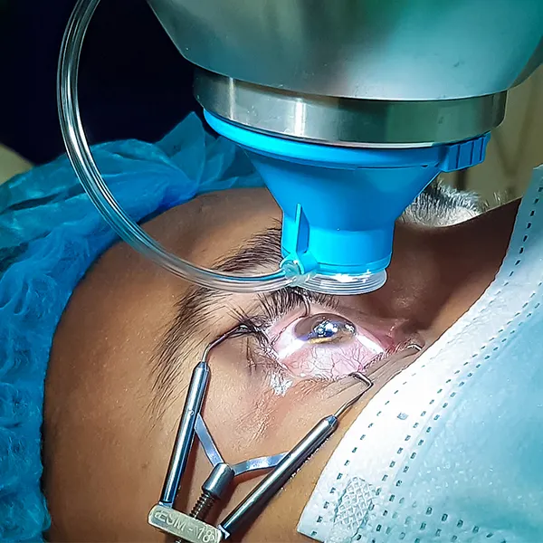 Best Eye Care Treatment in Silchar